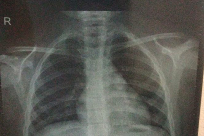 
					Debu Batubara Membuat Polusi Udara Kian Buruk, Penderita ISPA Terus Meningkat
